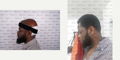 FUE Hair Transplant before and after photo