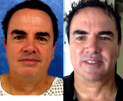 Neck Lift before and after photo