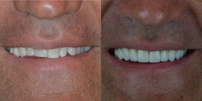 Smile Makeover before and after photo