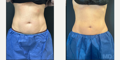 BodyTite before and after photo