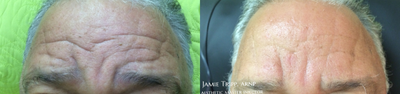 Botox before and after photo