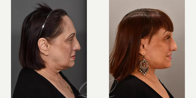 Brow Lift before and after photo
