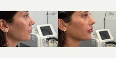 Cheek Fillers before and after photo