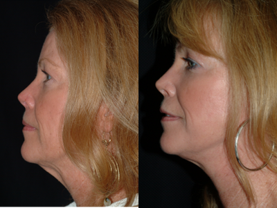 Facelift before and after photo