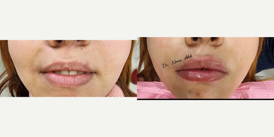 Lip Fillers before and after photo