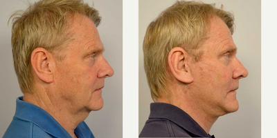 Lower Facelift before and after photo