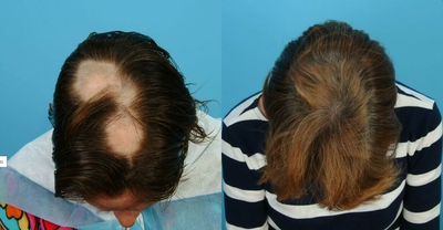 PRP for Hair Loss before and after photo
