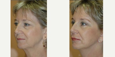 Chemical Peel before and after photo
