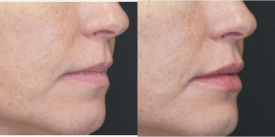 Juvederm before and after photo