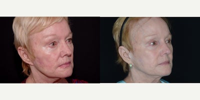 Bellafill before and after photo