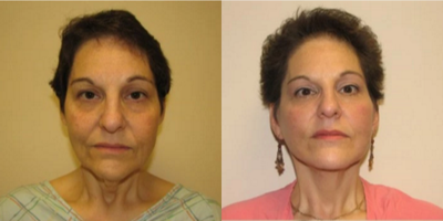 Facelift before and after photo