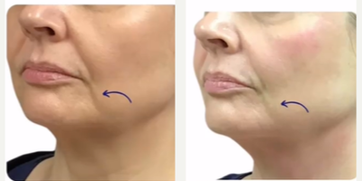 Skin Tightening before and after photo