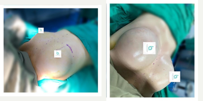 Breast Implants before and after photo