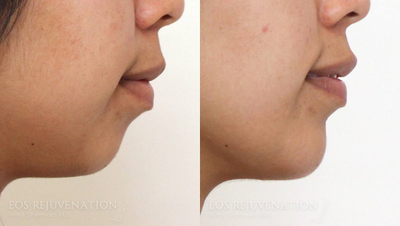 Chin Implant before and after photo