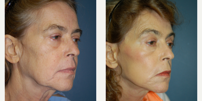 Facelift before and after photo