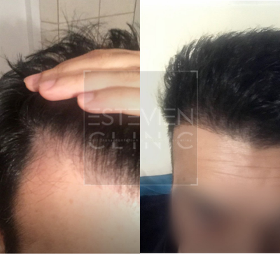 Hair Transplant before and after photo
