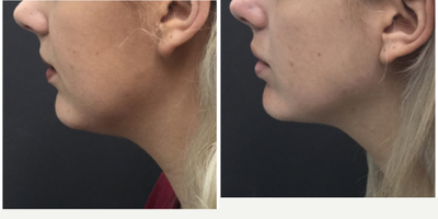 Kybella before and after photo