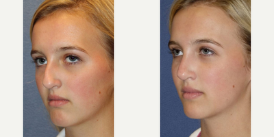Rhinoplasty before and after photo