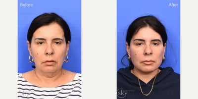 Deep Plane Facelift before and after photo