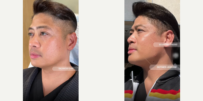 Dermal Fillers before and after photo