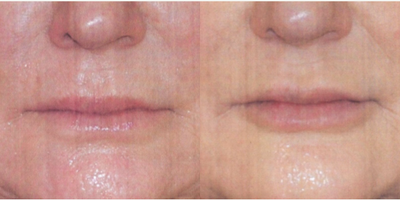 Lip Fillers before and after photo
