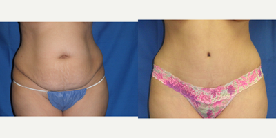 Tummy Tuck before and after photo