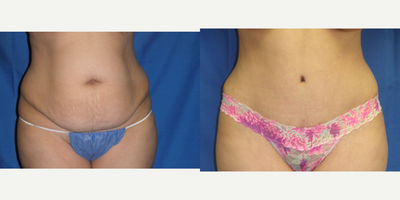 Tummy Tuck before and after photo