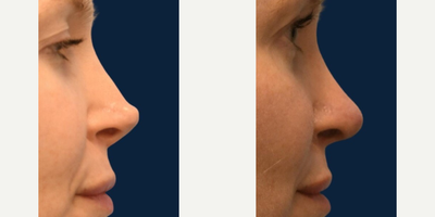 Revision Rhinoplasty before and after photo