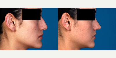 Rhinoplasty before and after photo