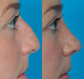 Rhinoplasty before and after photo