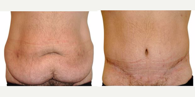 Male Tummy Tuck before and after photo