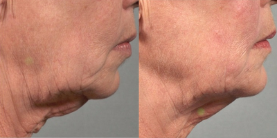 Ultherapy before and after photo