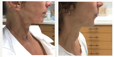 Ultherapy before and after photo