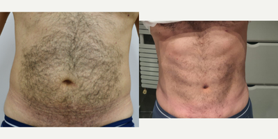 Abdominal Etching before and after photo