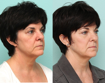 Laser Resurfacing before and after photo