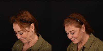 Neck Lift before and after photo