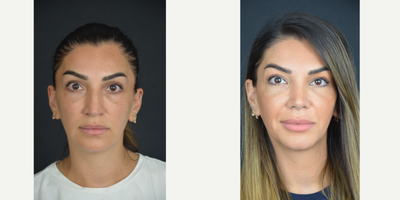 Rhinoplasty before and after photo