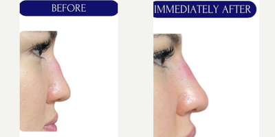 Voluma before and after photo