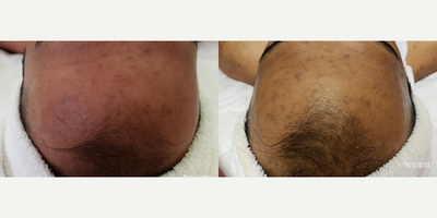 Chemical Peel before and after photo