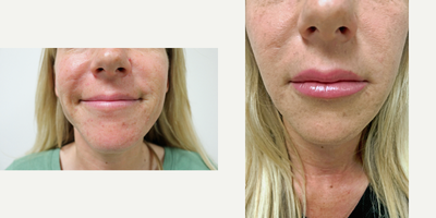 Juvederm before and after photo