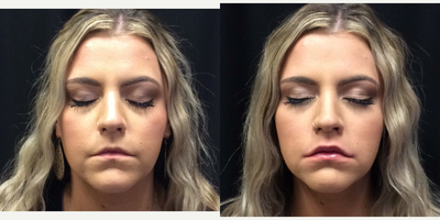 Juvederm before and after photo