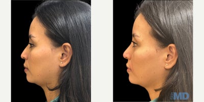 Nonsurgical Nose Job before and after photo