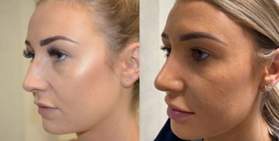 Rhinoplasty before and after photo