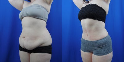 Tummy Tuck before and after photo