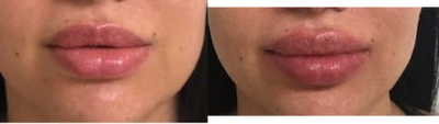 Volbella before and after photo