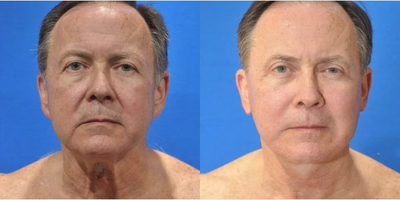 Neck Lift before and after photo