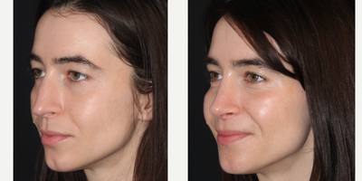 Revision Rhinoplasty before and after photo