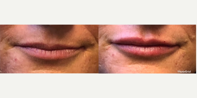 Lip Fillers before and after photo