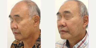 MACS Facelift before and after photo