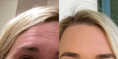 Botox before and after photo